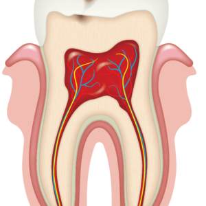 Caries